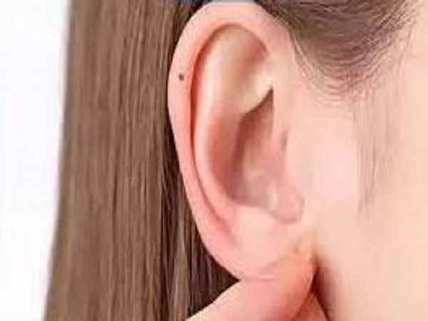 Mụn ruồi ở vành tai bên phải nữ giới