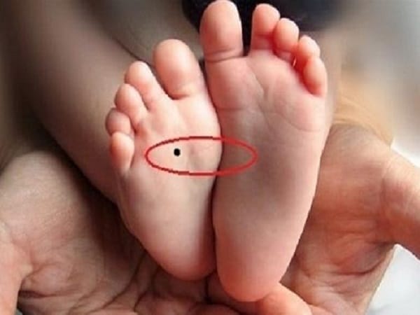 Ý nghĩa chung của nốt ruồi ở lòng bàn chân